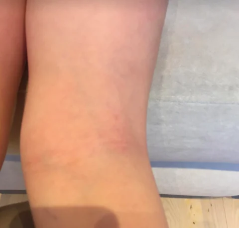 Prie Ingridos atsiliepimo pridėta nuotrauka: kojos oda ties kelio linkiu, matomas paraudimas.